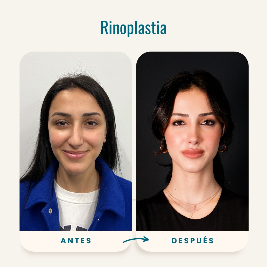 Fotos de antes y después de rinoplastia (cirugía de nariz)-6