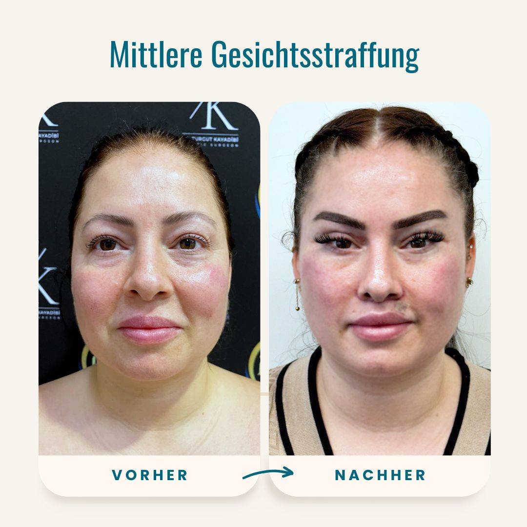 Vorher-nachher-Fotos der mittleren Gesichtsstraffung-1