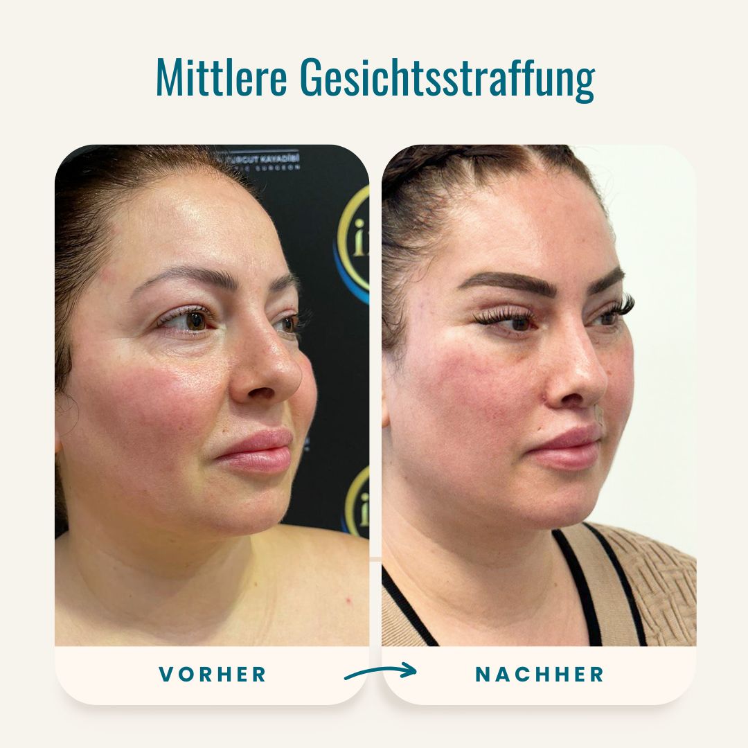 Vorher-nachher-Fotos der mittleren Gesichtsstraffung-2