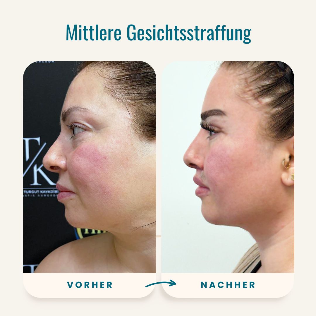 Vorher-nachher-Fotos der mittleren Gesichtsstraffung-3