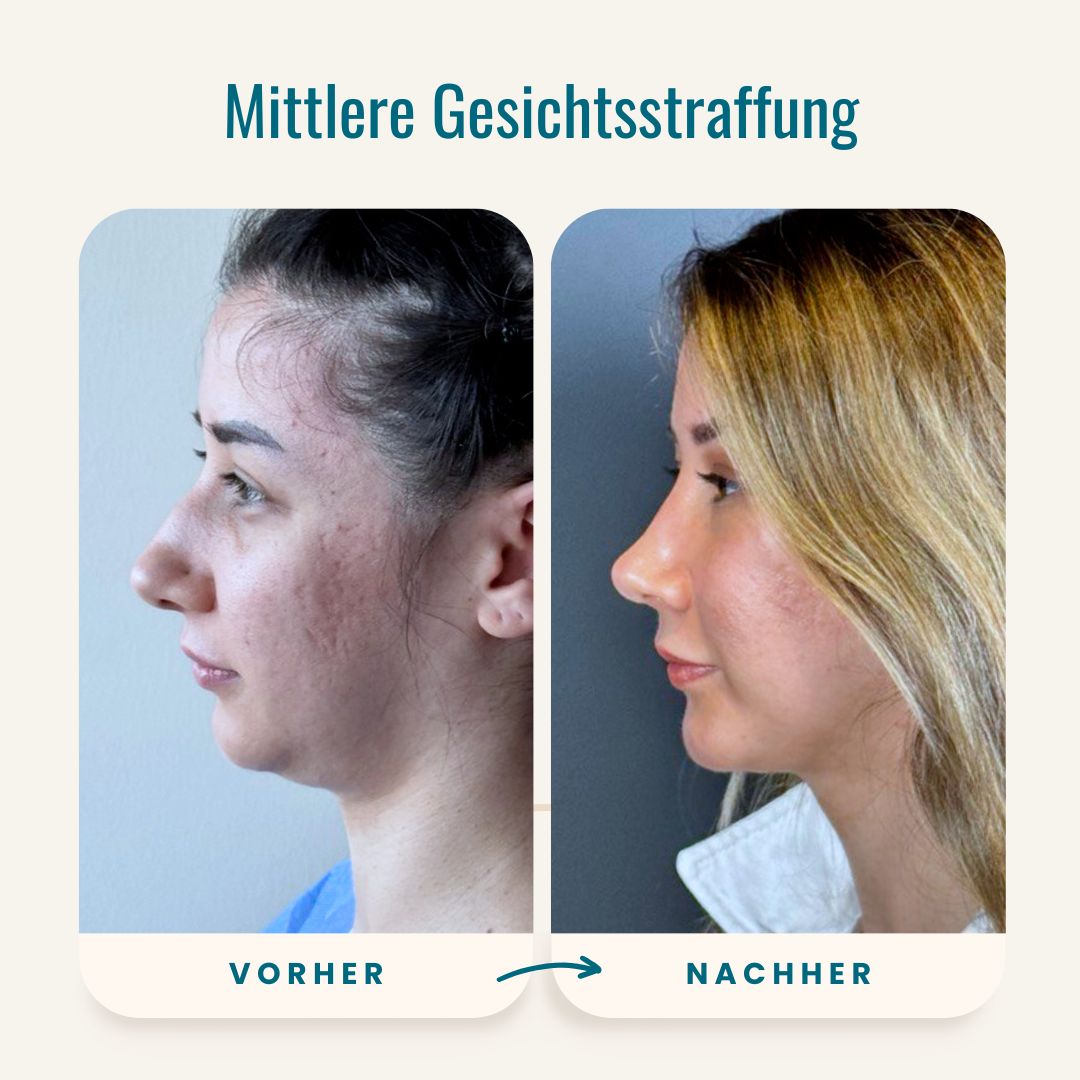 Vorher-nachher-Fotos der mittleren Gesichtsstraffung-5