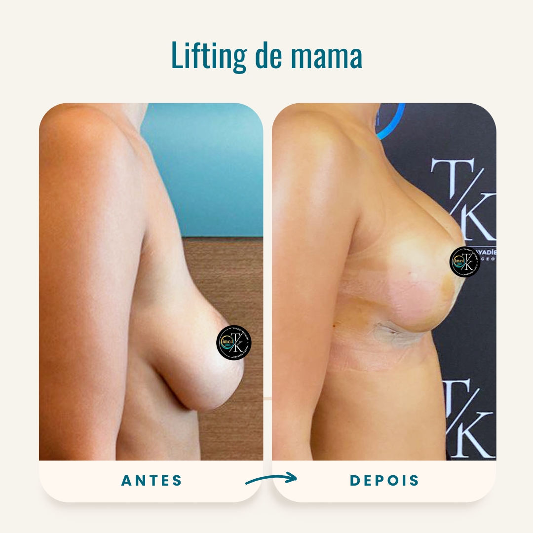 Fotos de antes e depois do lifting de mama-2