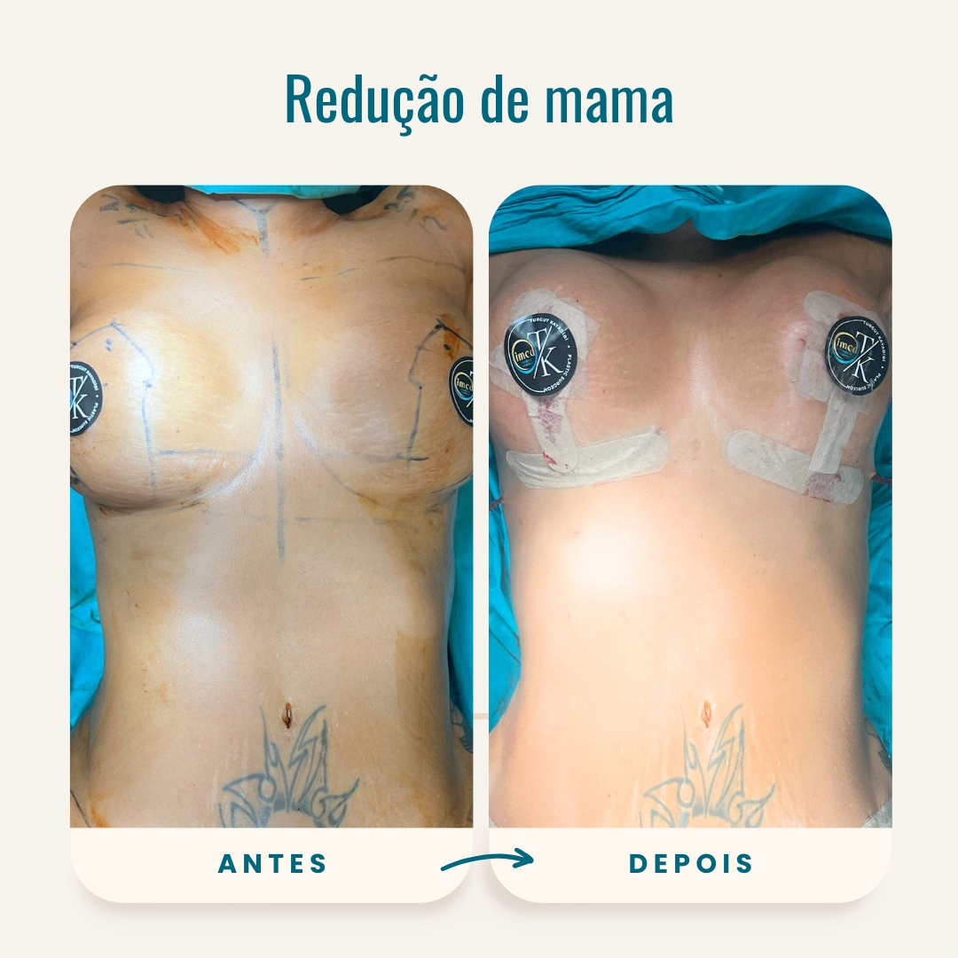 Fotos de antes e depois da redução de mama-1