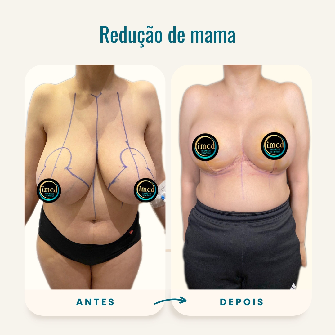 Fotos de antes e depois da redução de mama-2