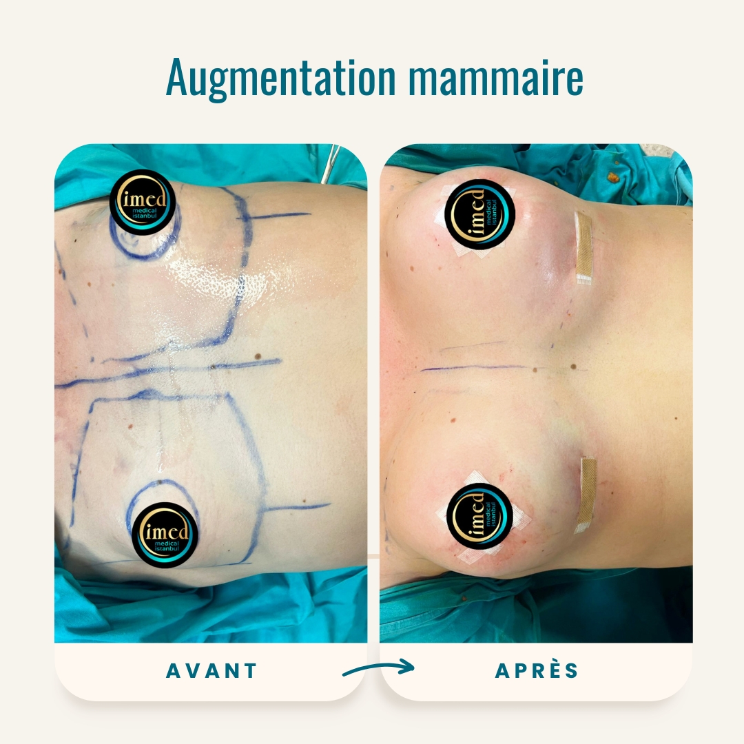 Photos de l'augmentation mammaire avant et après-2