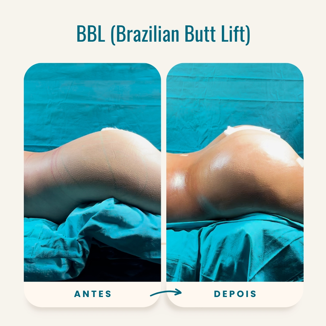 Fotos do Brazilian Butt Lift (BBL) antes e depois-5