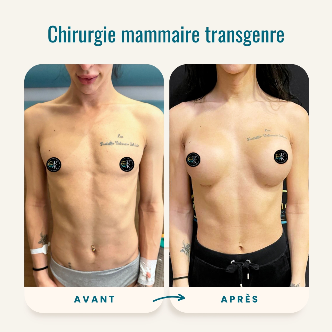 Photos avant-après de la chirurgie mammaire transgenre-1