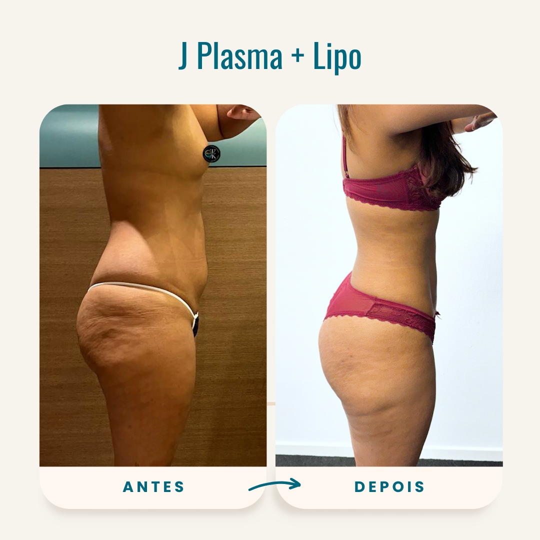 Fotos de antes e depois de J plasma + lipo-3