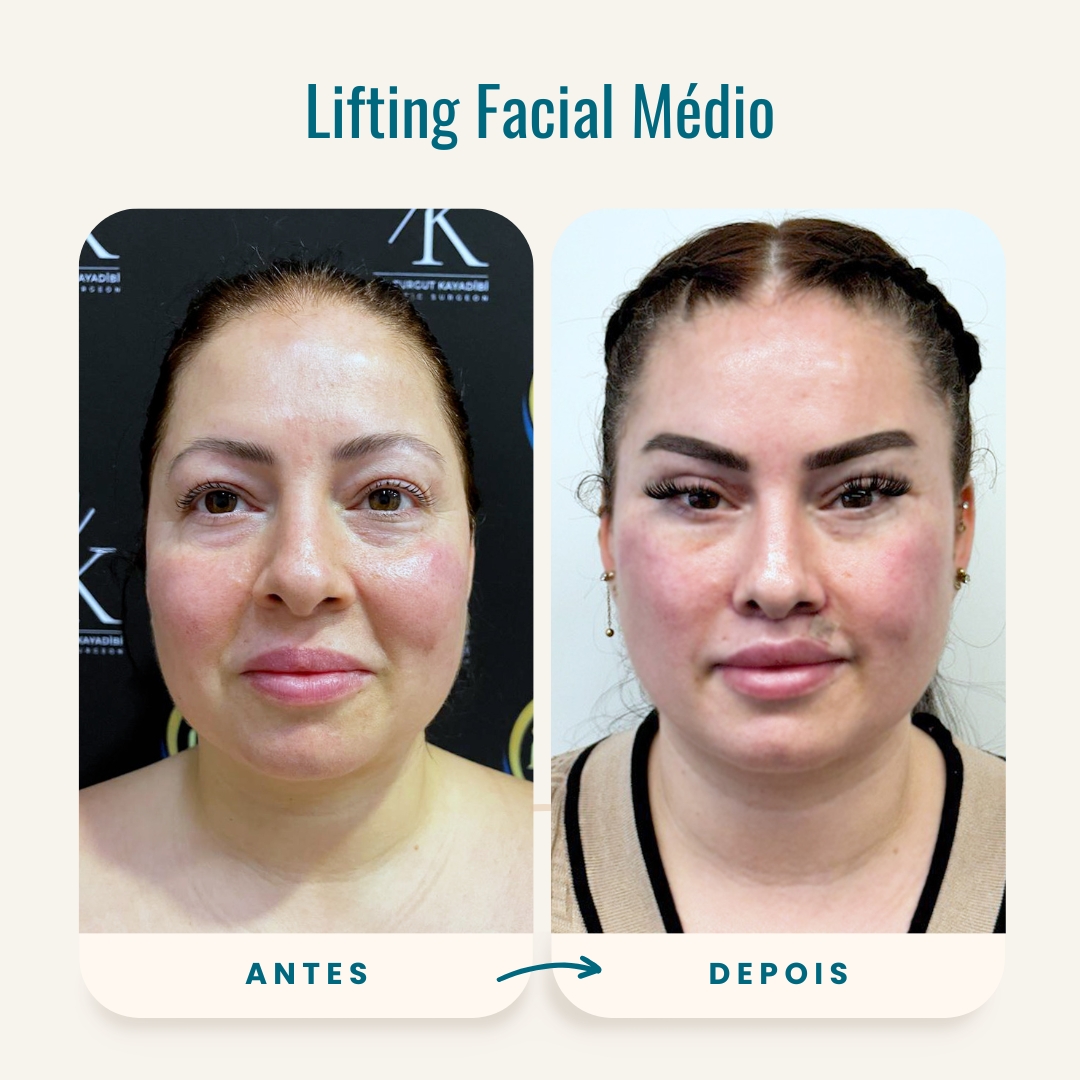 Fotos de antes e depois do lifting facial médio-1