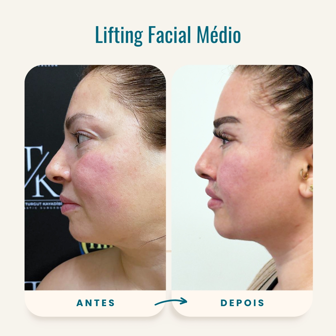 Fotos de antes e depois do lifting facial médio-3