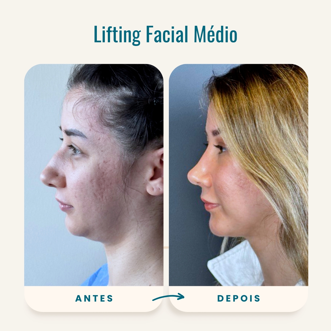 Fotos de antes e depois do lifting facial médio-5