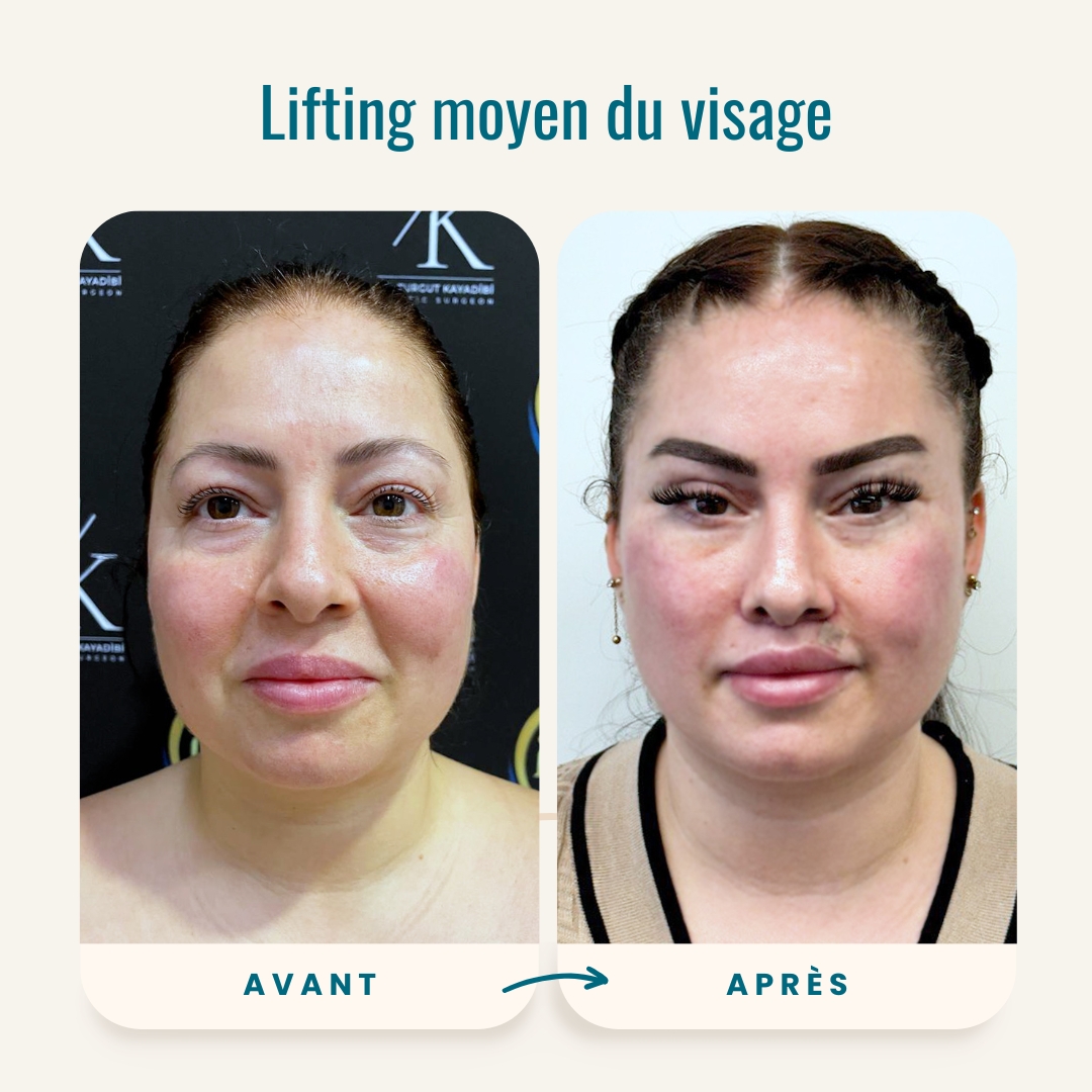 Photos avant-après du lifting moyen du visage-1