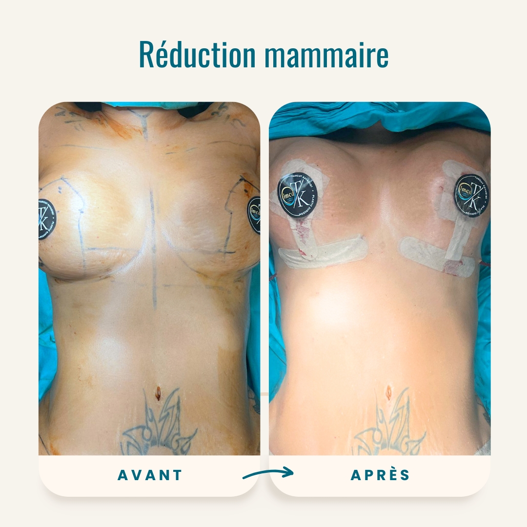 Réduction mammaire avant et après photos-1