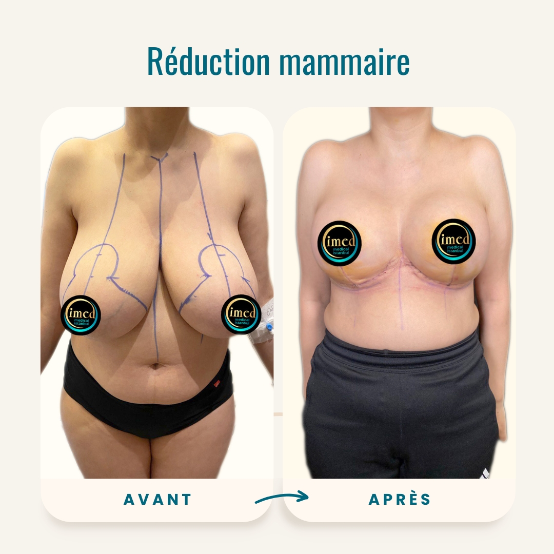 Réduction mammaire avant et après photos-2