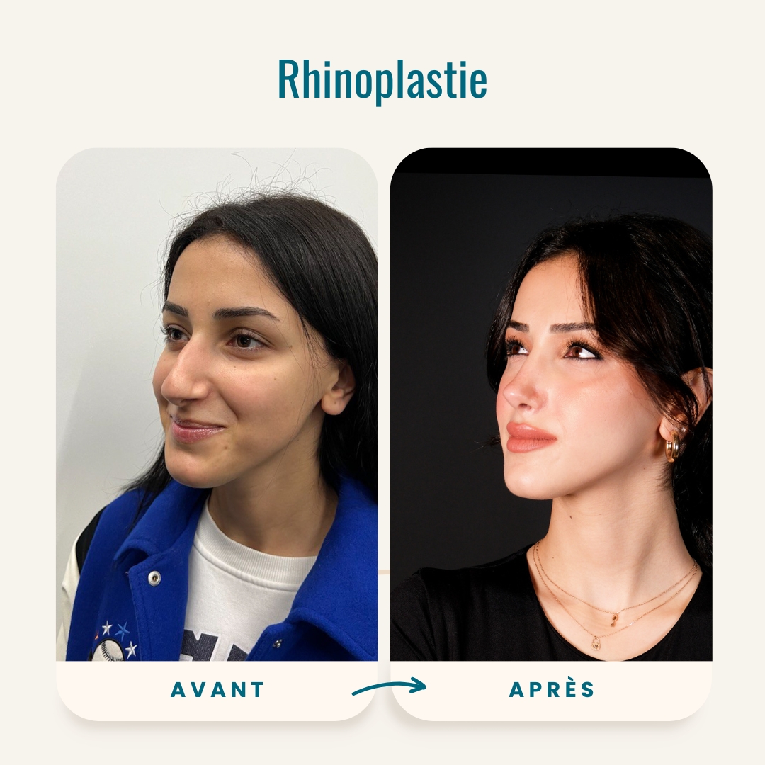 Photos avant-après de la rhinoplastie-4