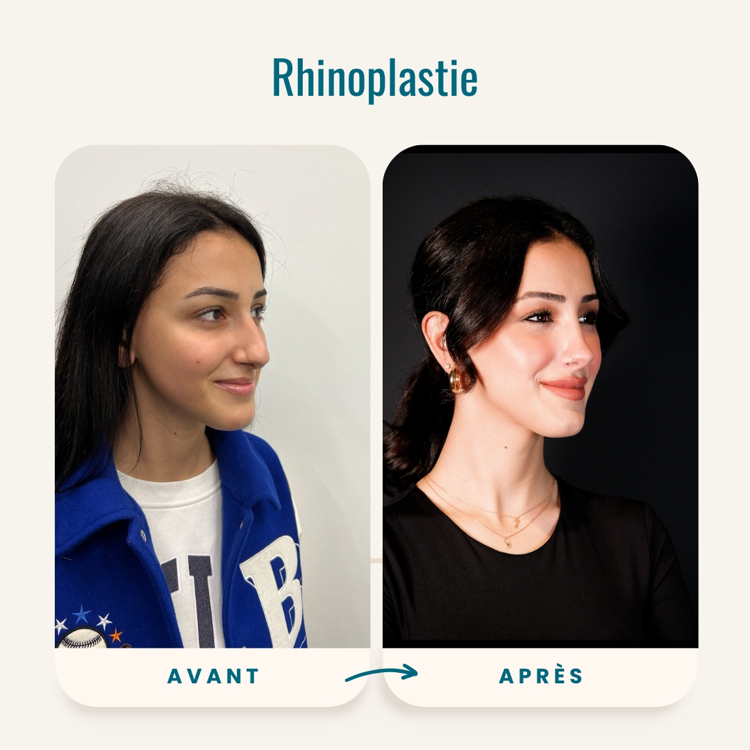 Photos avant-après de la rhinoplastie-5