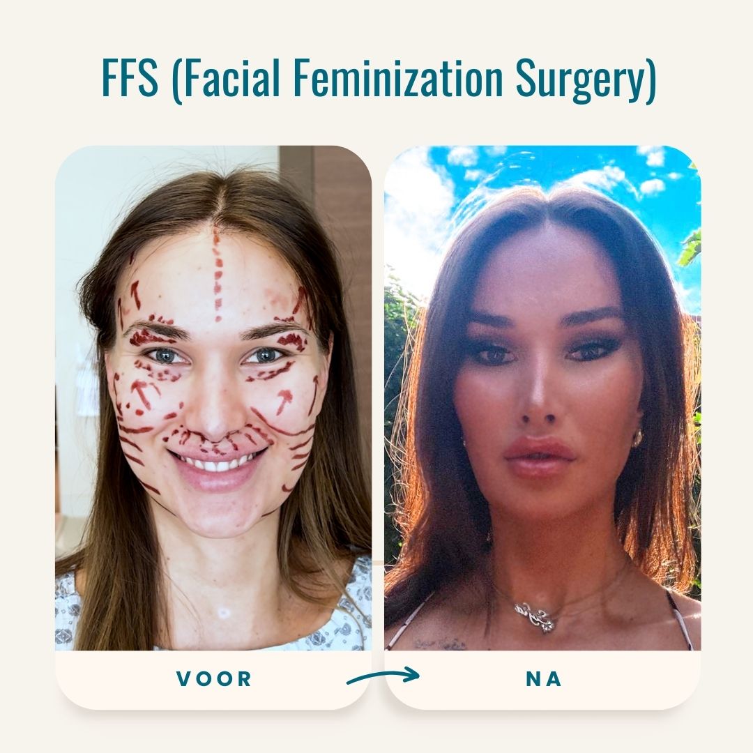 FFS (Facial Feminization Surgery) voor-na foto's-3