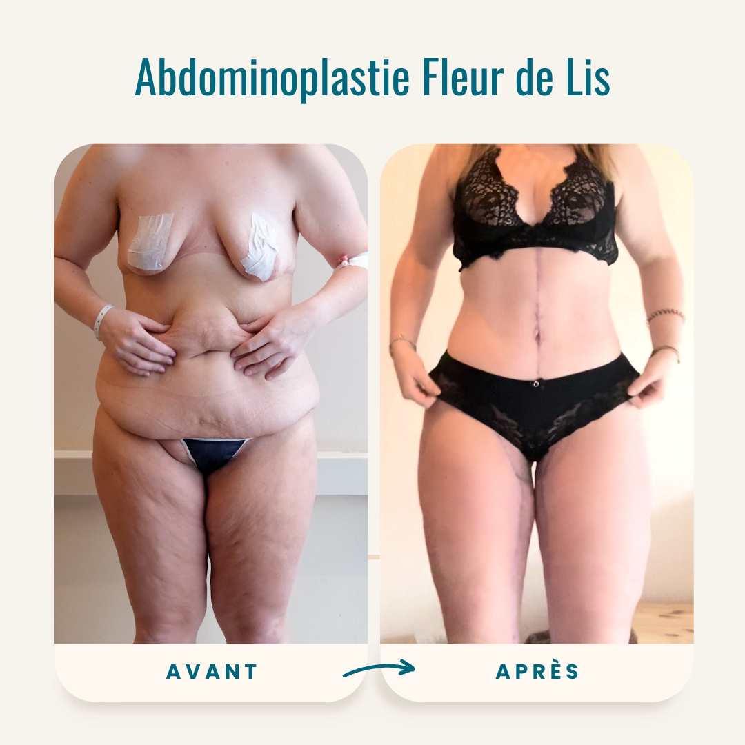 Photos avant-après de l'abdominoplastie Fleur de Lis-1