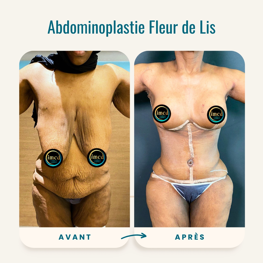 Photos avant-après de l'abdominoplastie Fleur de Lis-2