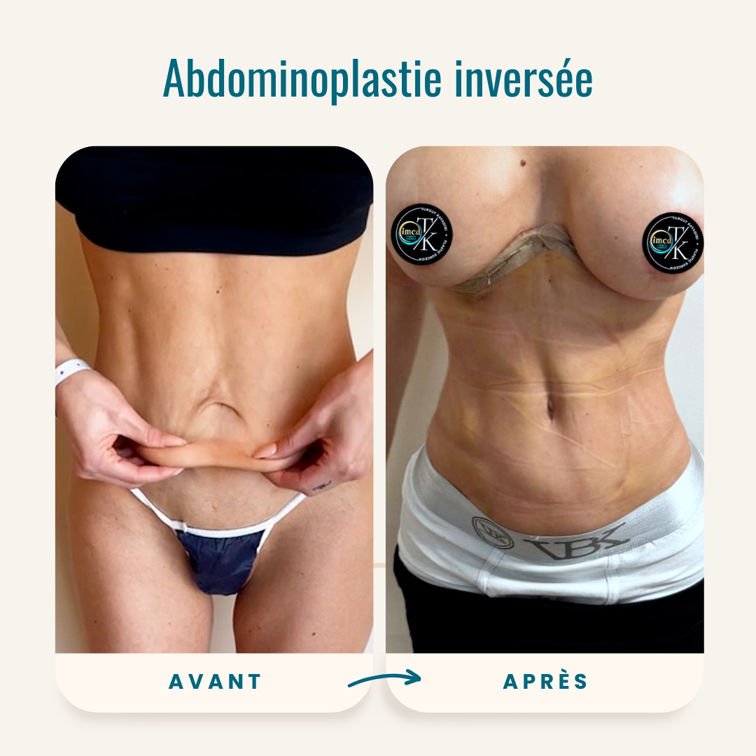 Photos avant-après de l'abdominoplastie inversée-1