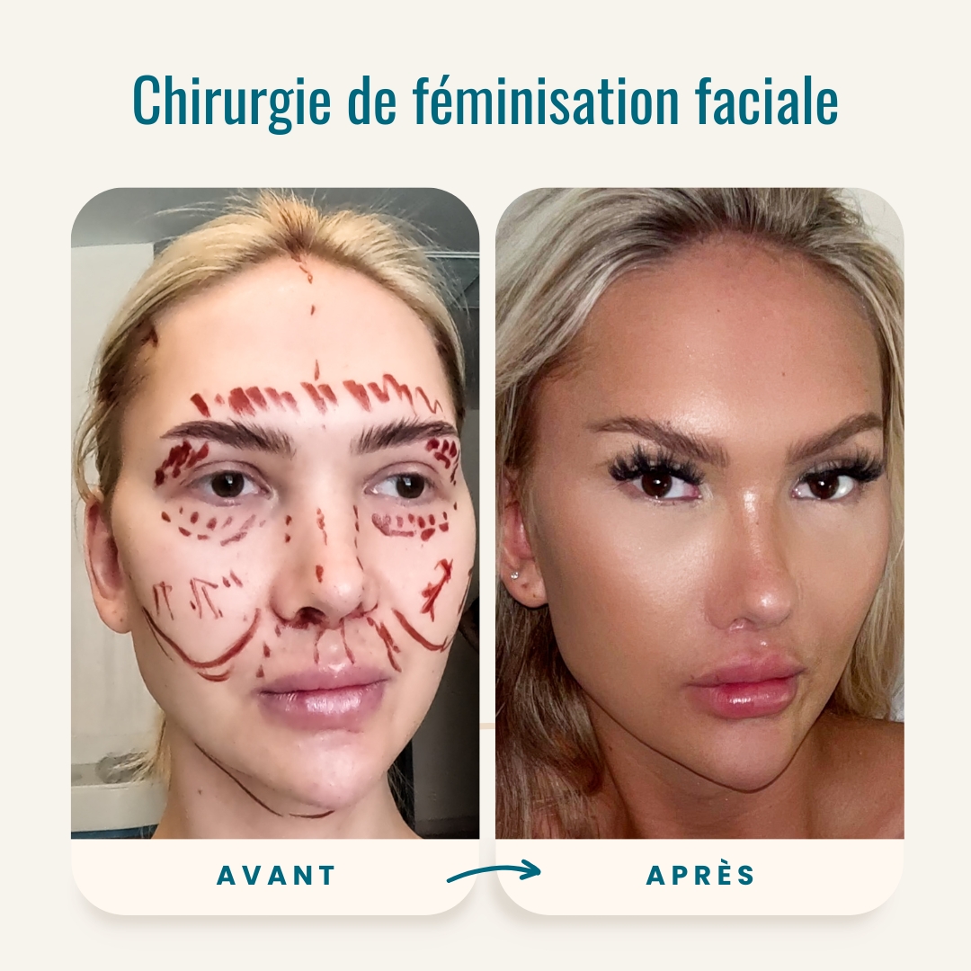 Photos avant-après de la chirurgie de féminisation faciale-1