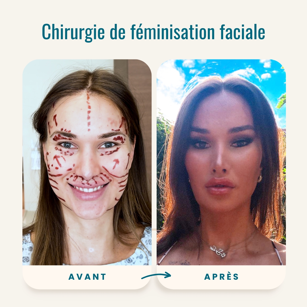 Photos avant-après de la chirurgie de féminisation faciale-2