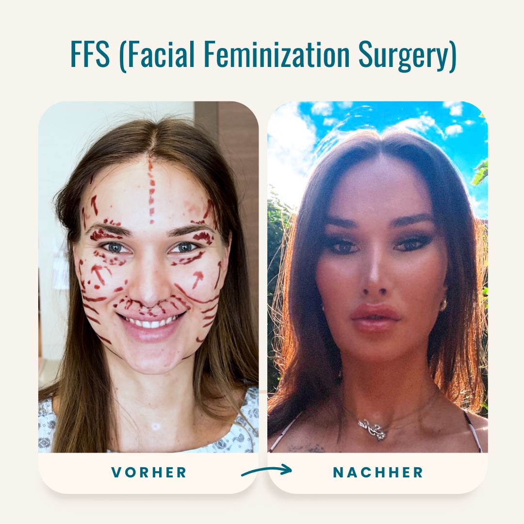 Vorher-nachher-Fotos der Facial Feminization Surgery (FFS)-2