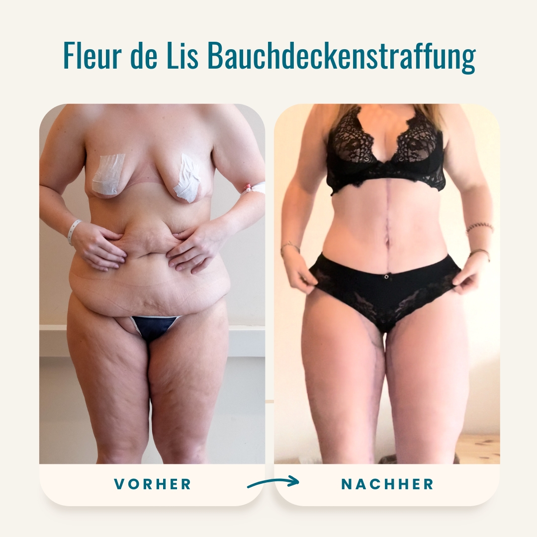 Vorher-nachher-Fotos der Fleur de Lis Bauchdeckenstraffung-1