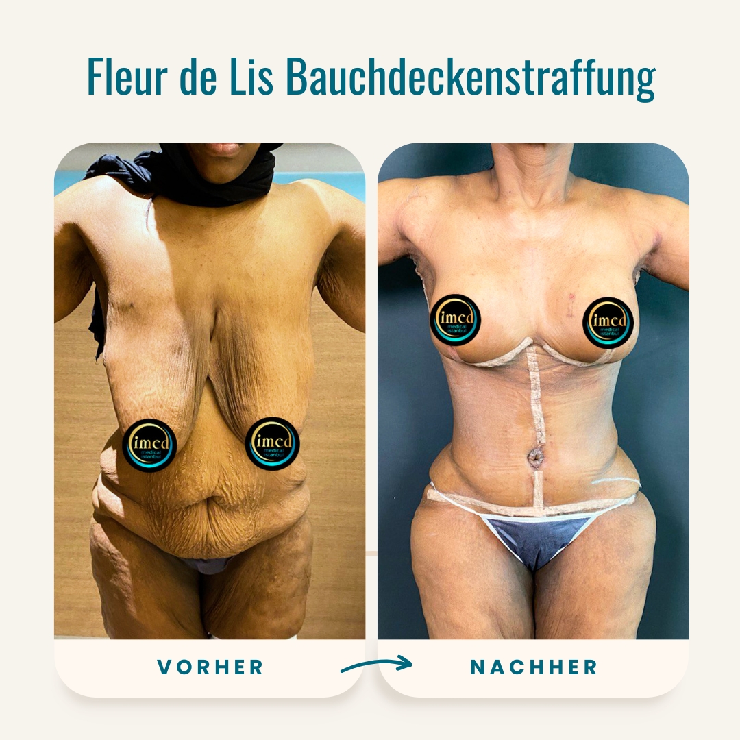 Vorher-nachher-Fotos der Fleur de Lis Bauchdeckenstraffung-2