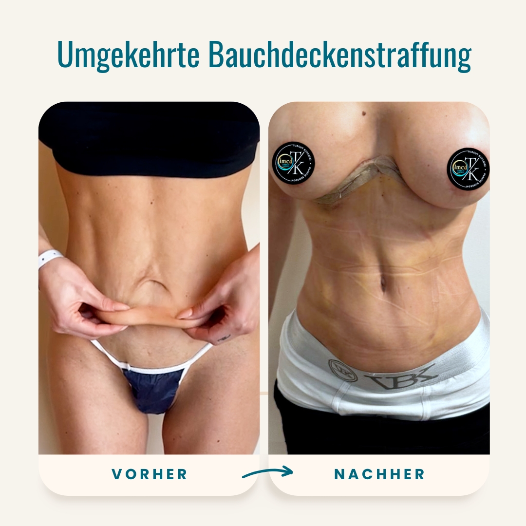 Vorher-nachher-Fotos der umgekehrten Bauchdeckenstraffung-1