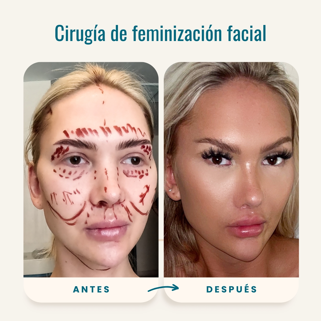 Fotos de antes y después de cirugía de feminización facial (FFS)-1