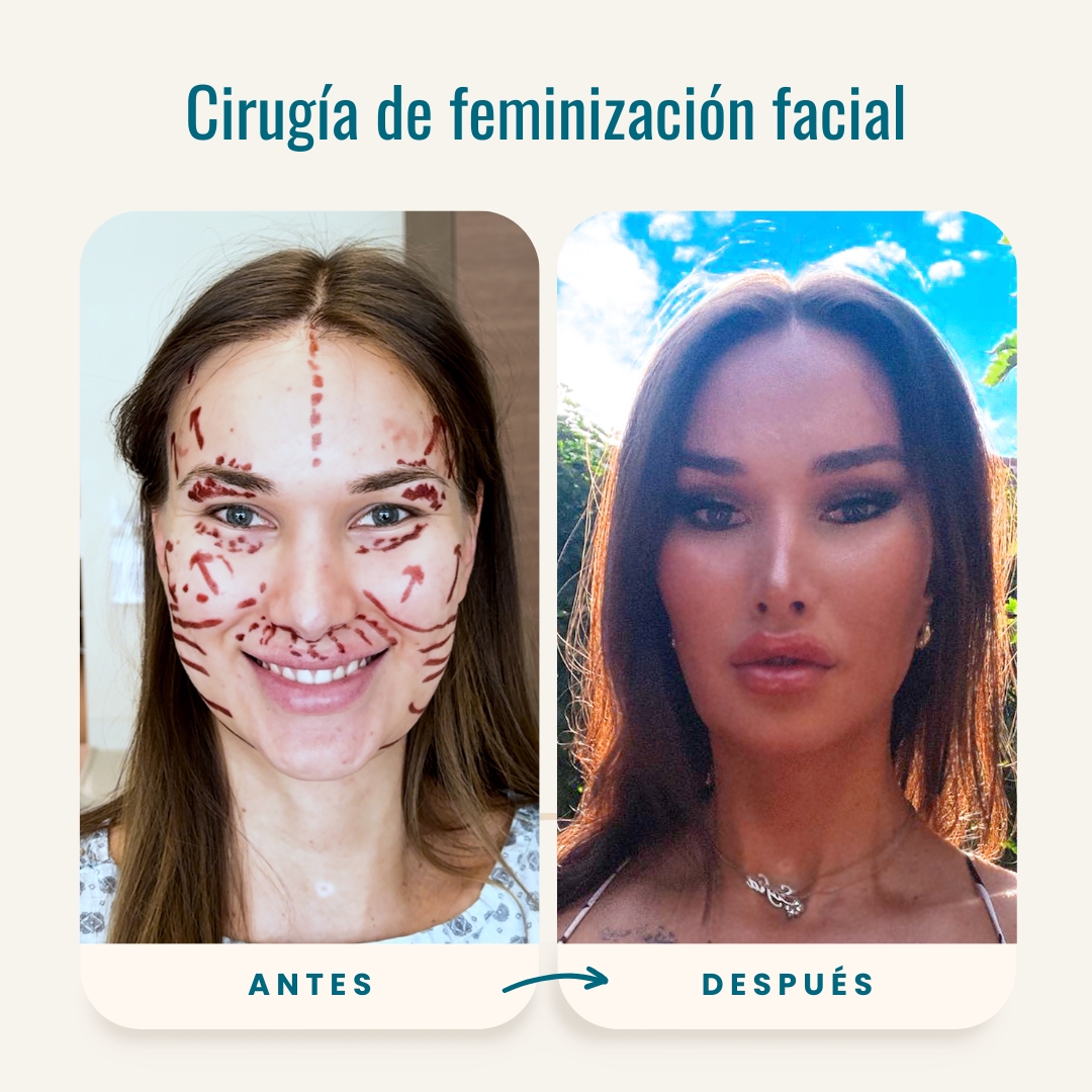 Fotos de antes y después de cirugía de feminización facial (FFS)-2