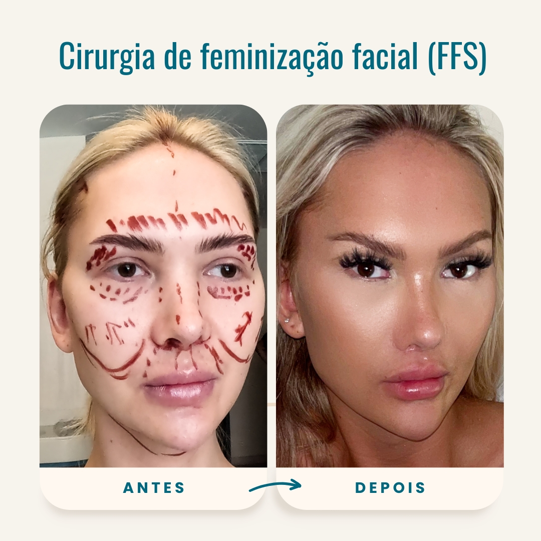 Fotos de antes e depois da cirurgia de feminização facial (FFS)-1