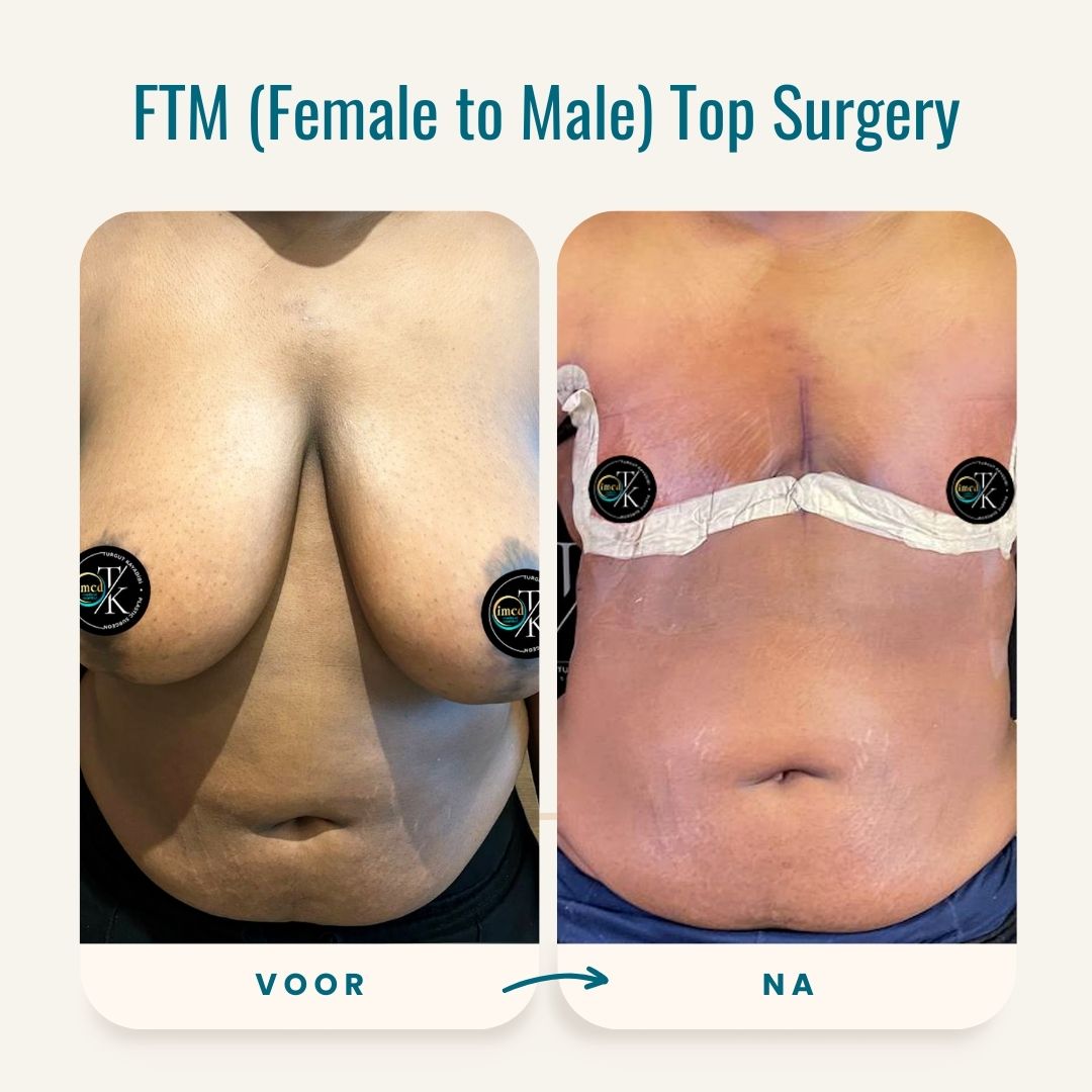 FTM Top Surgery voor-na foto's-1