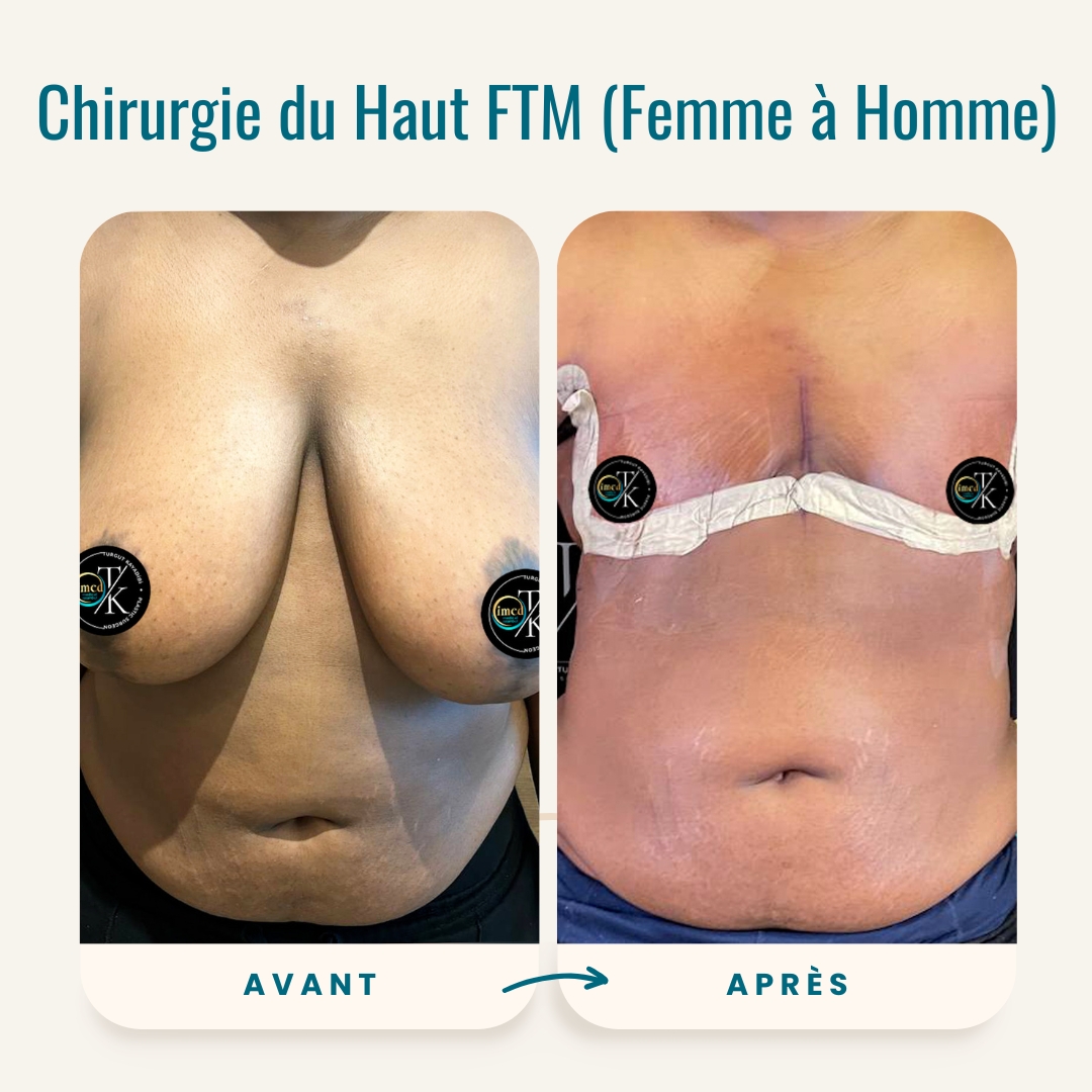 Photos avant-après de la chirurgie du haut FTM (Femme à Homme)-1